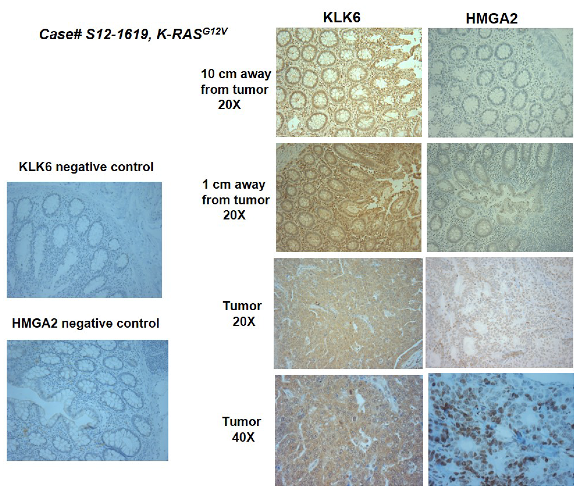 Figure 5: Representative images of KLK6 and HMGA2 IHC staining in the surgical material of a colon cancer patient.