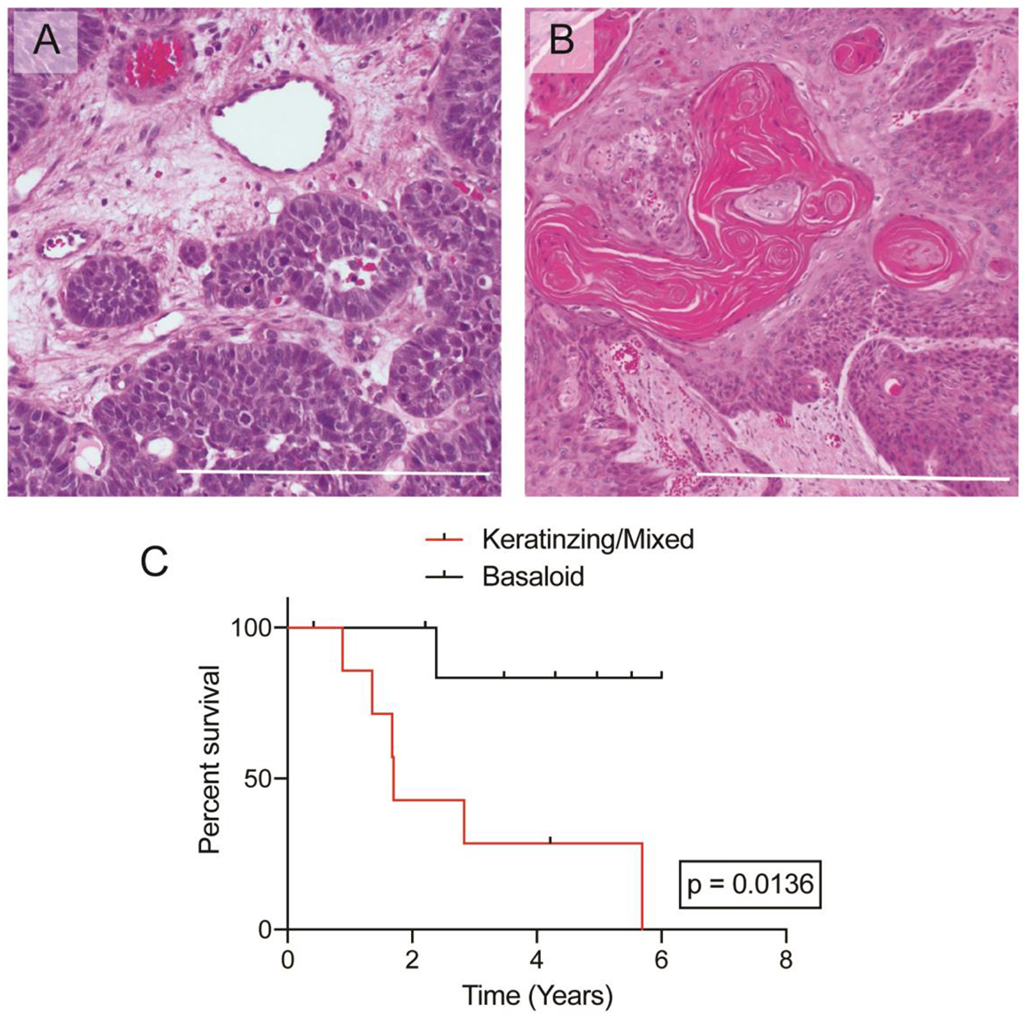 Overall survival analysis of GLUT1, PD-L1, and histologic architecture.
